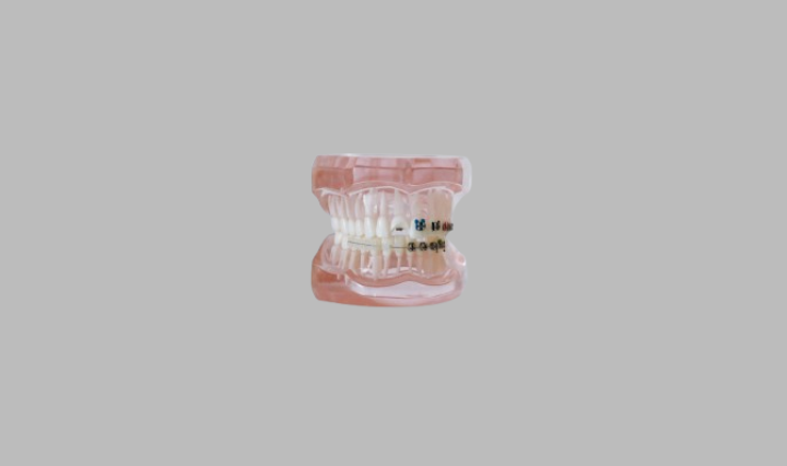 Aligners and Braces