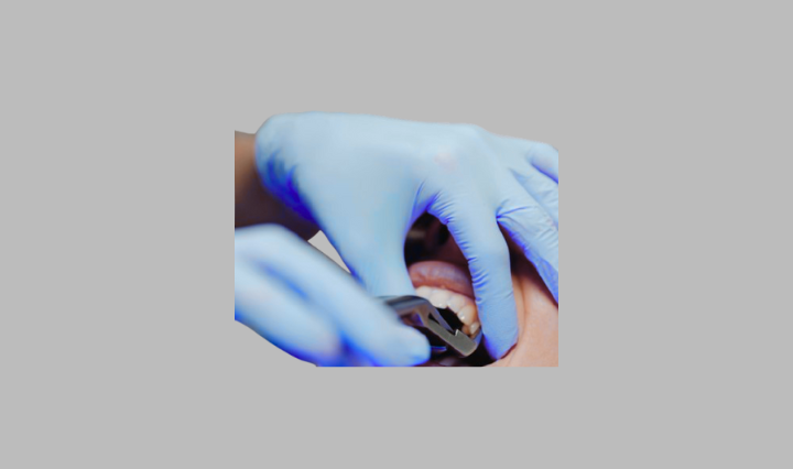 Teeth Extraction